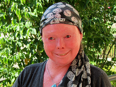 master's student Hunter Steinitz Harlequin ichthyosis 